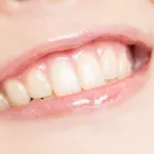 ホワイトニング