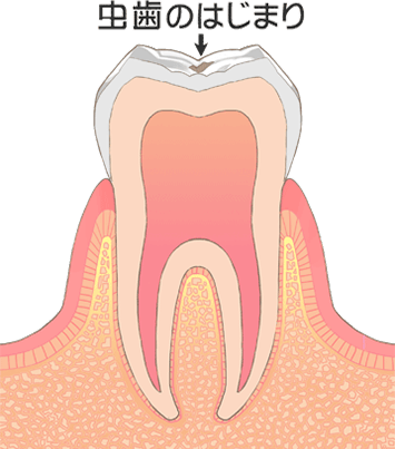虫歯：最初期（CO）イメージ