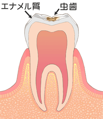 虫歯：初期（C1）イメージ