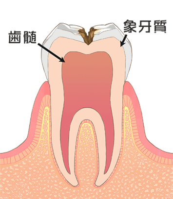 虫歯：中期（C2）イメージ