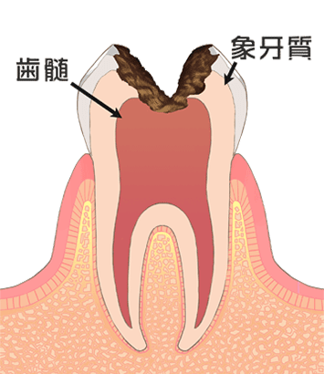 虫歯：後期（C3）イメージ