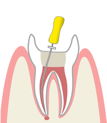 虫歯の神経を取るイメージ