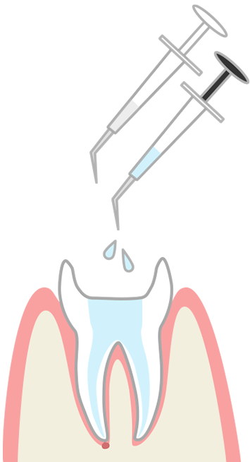 虫歯の根管を洗浄・消毒イメージ