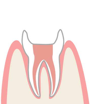 虫歯の神経の穴を薬で詰めるイメージ